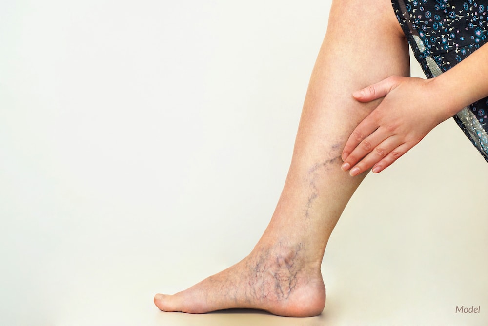 Women with varicose and spider veins before a laser treatment.