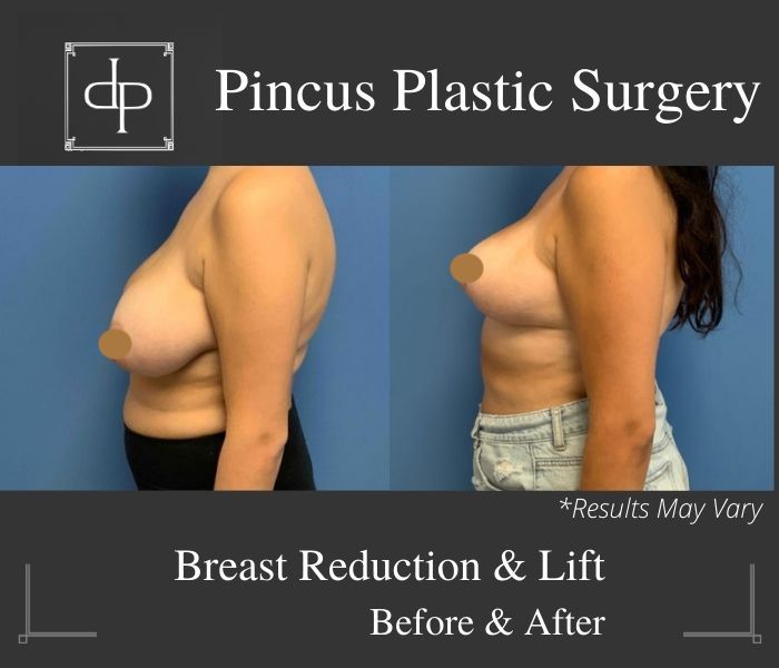 How Breast Reduction Surgery Can Improve Your Life