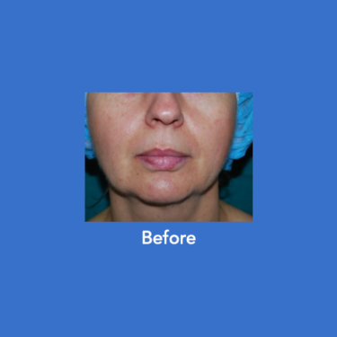 FaceTite Before & After Results - Pincus Plastic Surgery